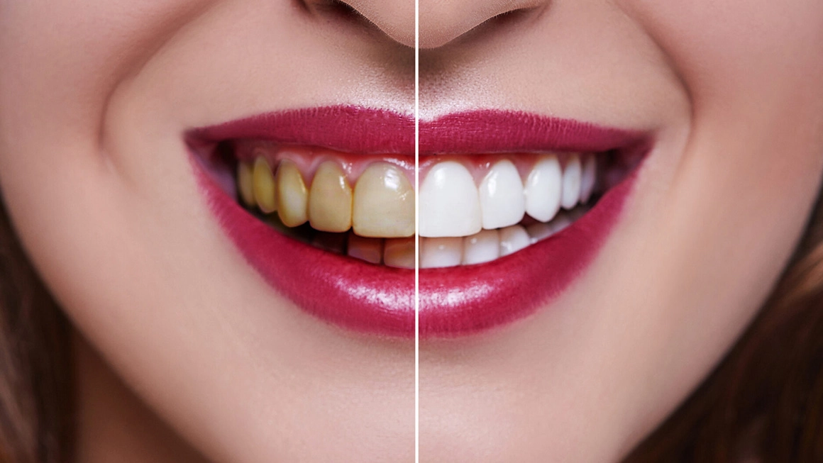 Vip Dental Care Diş Beyazlatma Adana